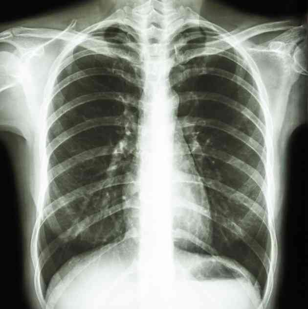 poate tumorile pulmonare benigne cauzează pierderea în greutate